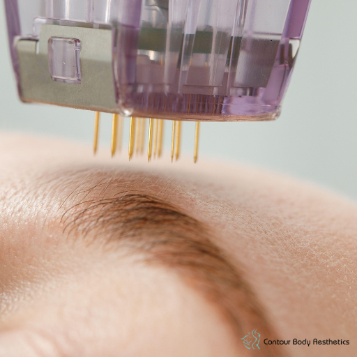 RF Microneedling: The Skin-Tightening Secret Everyone’s Talking About