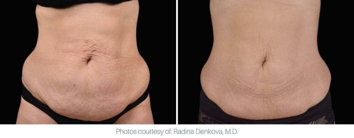 emsculpt_neo_before_and_after_10.jpg
