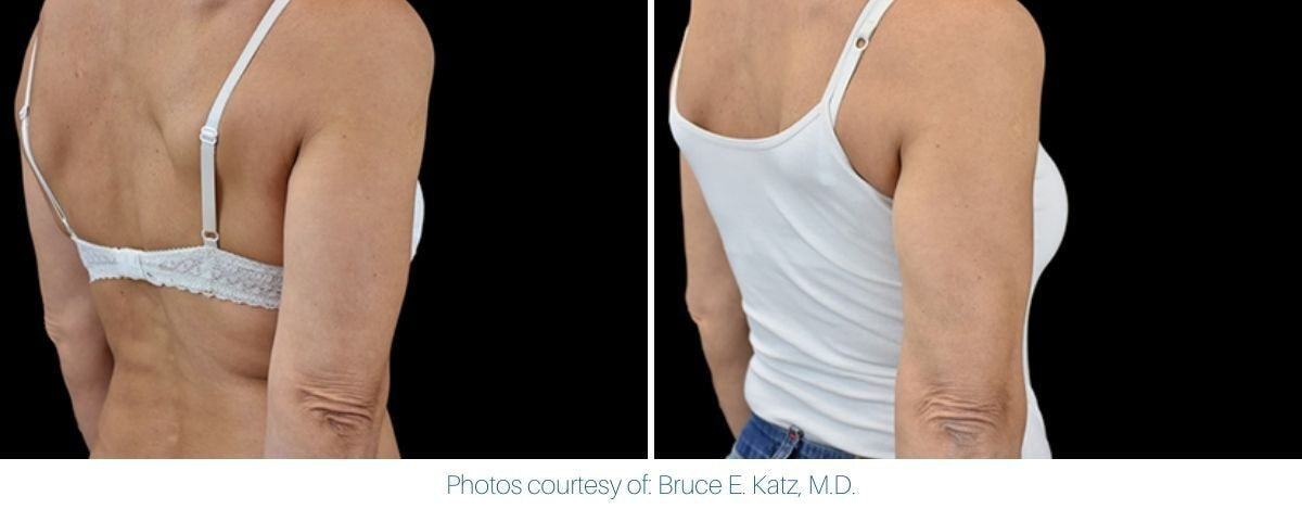 emsculpt_neo_before_and_after_4.jpg