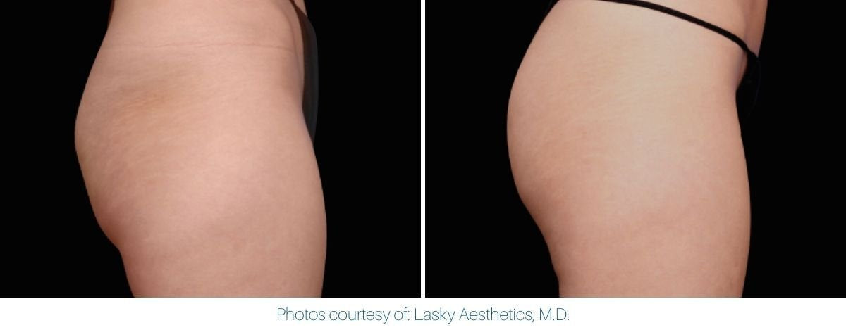 emsculpt_neo_before_and_after_6.jpg