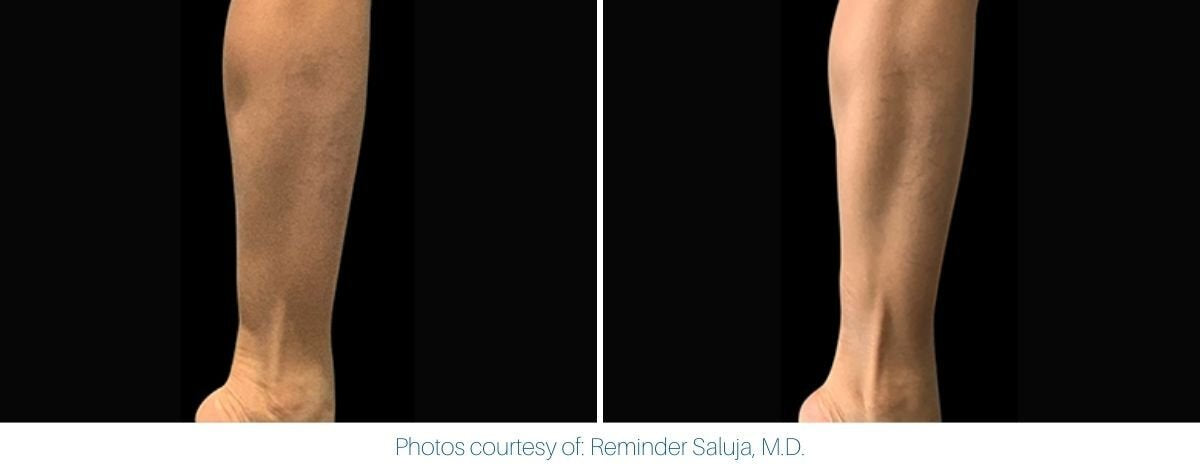 emsculpt_neo_before_and_after_8.jpg